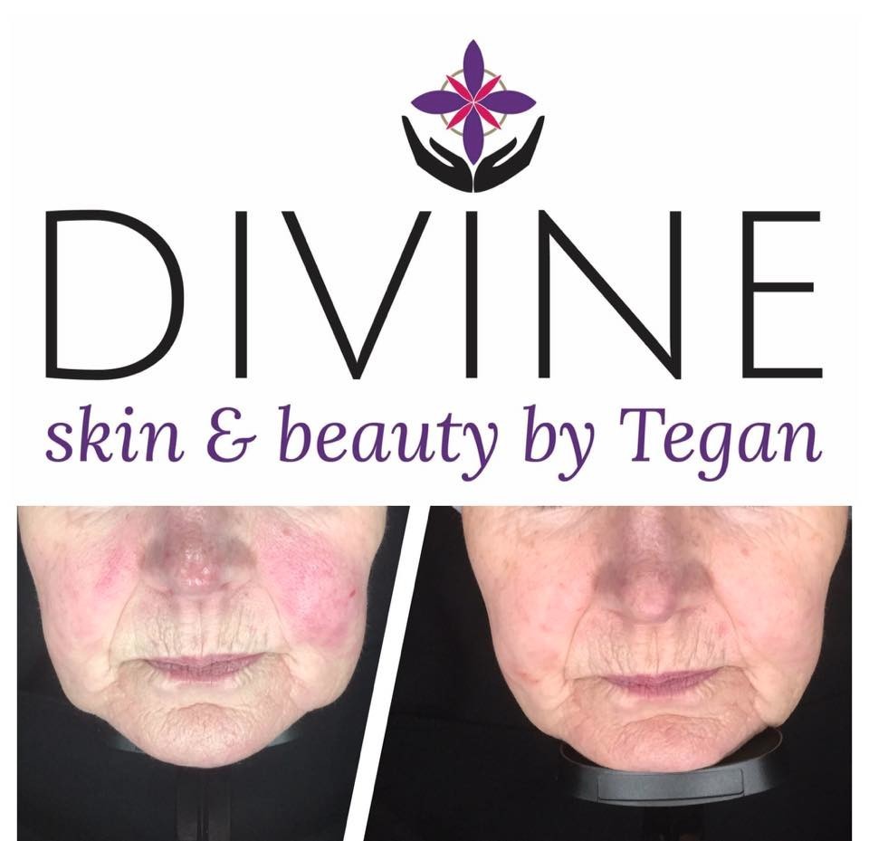 Permanently diffused redness is a skin type I treat ALOT in Taranaki. Here is a fabulous result achieved by strengthening and working exclusively on the  water and lipid bi layers.