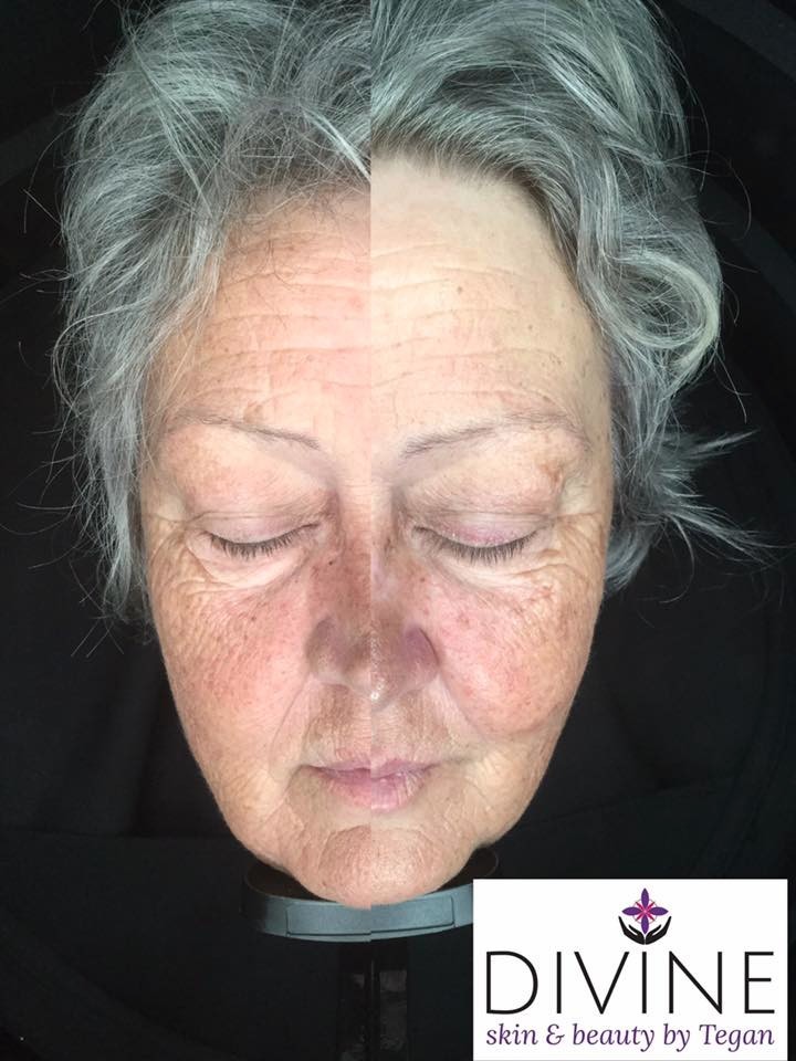 The difference a facial makes. Before and after the facial, such a huge increase in circulation and hydration.